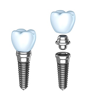 Dental Implants In Livingston, NJ